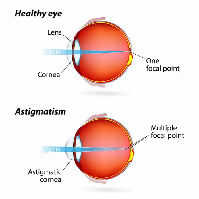 1747414448 astigmatism chart 1747414448 astigmatism chart