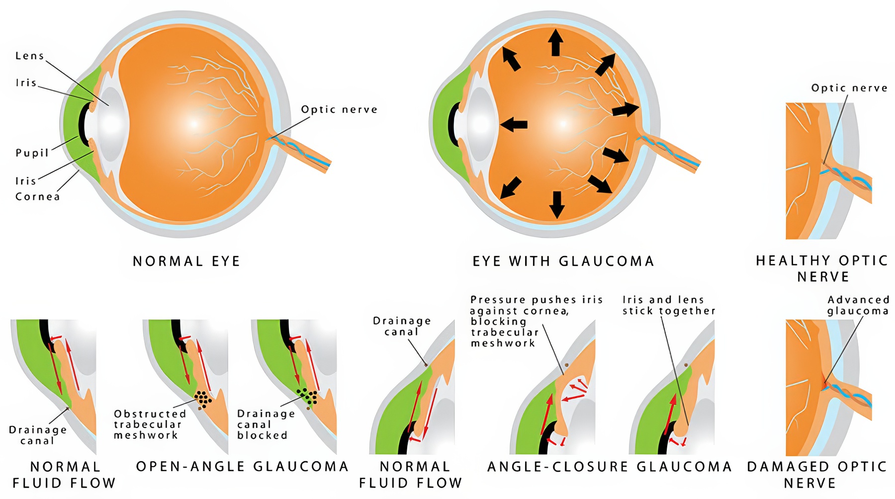 glaucoma types topaz text upscale 2x glaucoma types topaz text upscale 2x